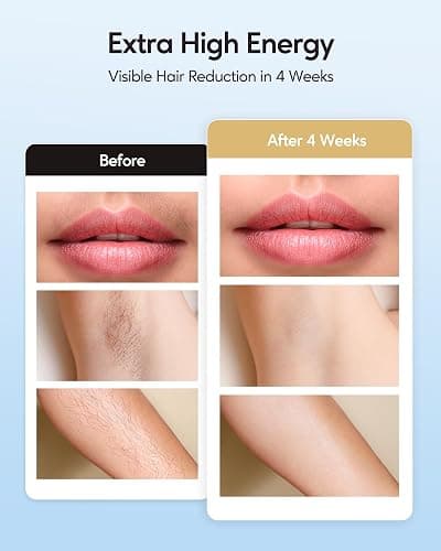 INNZA IPL Hair Removal with Ice Cooling Care Function for Women,Long-Lasting Results,999,999 Flashes Painless Hair Removal, Hair Removal Device for Armpits Legs Arms Bikini Line,Corded thumbnail 3