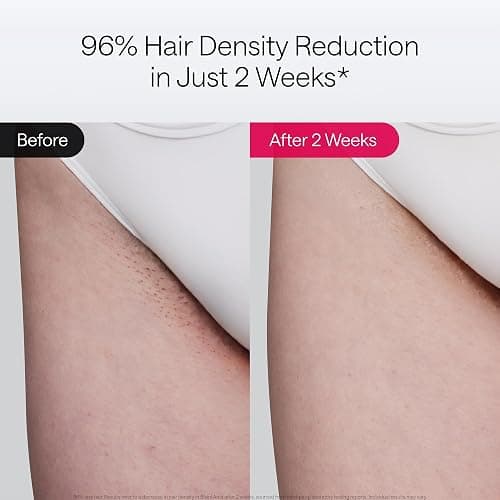 Ulike Laser Hair Removal Device Air 10 Ipl Gift for Women and Men, Ice Cool and Permanent Hair Reduction for Nearly Painless, Dual Lights, Skin Sensor & USHR Mode Hair Removal in 10mins from Home thumbnail 4