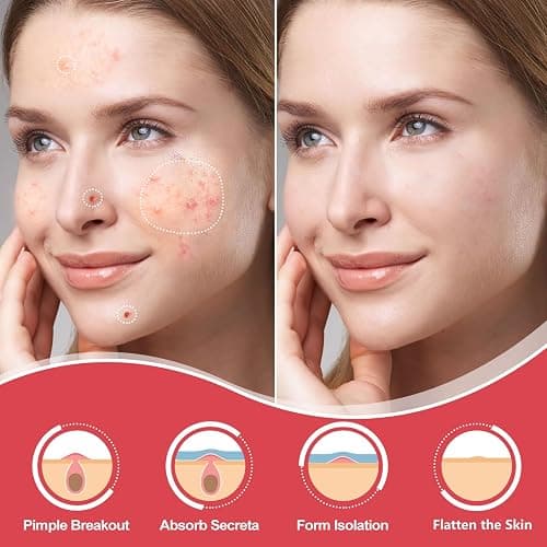 AcneGo 432 Counts Pimple Patches for Face, Hydrocolloid Acne Patches Zit Patches for Face Acne Spot Treatment Patch Cystic Acne Treatment Stickers Blemish Hydrocolloid Patches for all Skin Type thumbnail 2