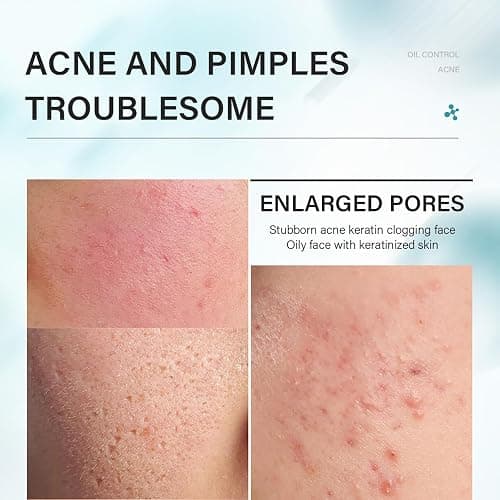 Tea Tree Acne Skin Care Sets & Kits - Salicylic Acid Acne Removal Skincare Set - Teen Skincare Gift Set With Cleanser, Toner, Serum, Cream - Complete Acne Treatment Kit for Oily, Acne-Prone Skin thumbnail 2