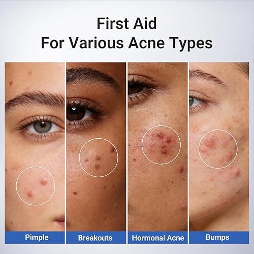 Dr.Leo 1.8% Salicylic Acid Spot Serum, Acne Treatment for Acne-Prone Sensitive Skin | Niacinamide, Fast Pimple Relief, Fades Acne Marks, Overnight & Period Breakouts, 0.34 fl oz (20 ml) thumbnail 5