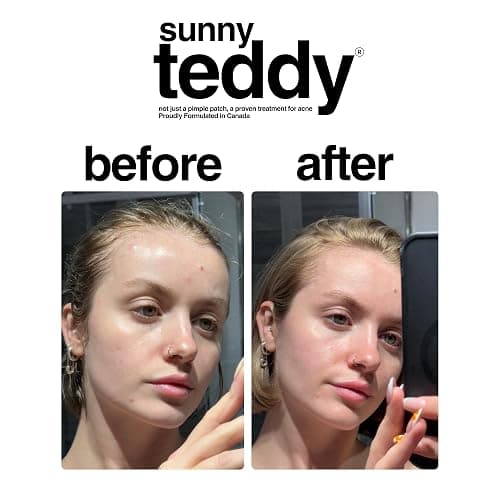 Sunny Teddy's Acne Treatment Patches, 72 Invisible Dots, Medical Grade Salicylic Acid, Hydrocolloid, Aloe Vera, Canadian Anti-Acne Facial Pimple Patches, Day/Night Use thumbnail 3