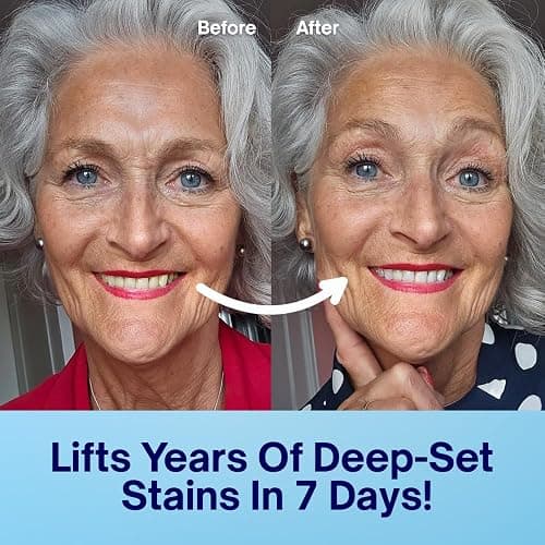 MySweetSmile Dentist-Approved Teeth Whitening Strips – IndyBest Winners 2023 & 2024 – Whiter Teeth in 7 Days – 21 Treatments – Reverses Years of Yellowing – Non-Slip & Sensitivity-Free – Pap Formula thumbnail 3