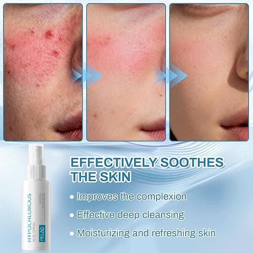 Ácido hipocloroso Spray, Spray para rostro, seguro en la piel | aplicable en cuero cabelludo seco, Hidrata y protege tu piel (60ml) thumbnail 5