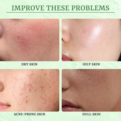 YTRAJU Anti Acne Face Mask Salicylic Acid Face Masks Skincare, Hydrating Face Masks, Soothing Facial Sheet Masks Skin Care for Acne Prone, Acne Mask for Pimple Breakouts Oil Control, 10 Pack thumbnail 5