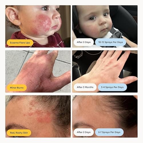 Magic Molecule Hypochlorous Acid Spray for Breakout-Prone Skin, Eczema & Itchy Rashes | Helps 50+ Dermal Issues | For All Skin Types 3.4 oz (Pack of 2) Travel-Friendly thumbnail 2