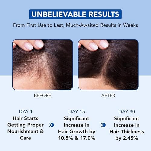 Botanic Hearth Rosemary Oil for Hair Growth | Strengthening Biotin, Jojoba, Castor Hair Growth Oil for frizzy hair | Dry, Damaged Scalp Treatment | Color Safe | All Hair Types | 6.7 Fl Oz thumbnail 4