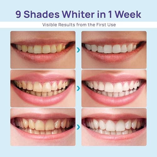 Whitebite Pro Teeth Whitening Kit for Sensitive Teeth – Dual LED Light + 35% Carbamide Peroxide Gel + Remineralizing Gel | Dental-Grade Whitening at Home thumbnail 2