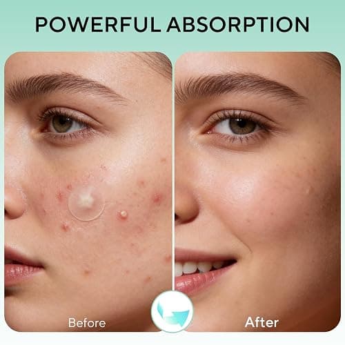 QUSTERE 580 Count Pimple Patches for Face, Large Hydrocolloid Acne Patches Stickers Bandages, Blemishes Zit Breakouts for Cheeks, Forehead, Chin, Nose for Full Face & Body | 7 Sizes | 4 Shapes thumbnail 4