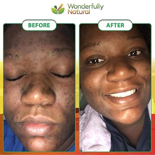 Wonderfully Natural #1 African Black Soap for Acne & Dark Spots | Organic Vegan Satisfaction Guarantee | 1lb bar 90 day Supply thumbnail 3