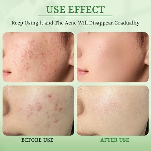 YTRAJU Anti Acne Face Mask Salicylic Acid Face Masks Skincare, Hydrating Face Masks, Soothing Facial Sheet Masks Skin Care for Acne Prone, Acne Mask for Pimple Breakouts Oil Control, 10 Pack thumbnail 7