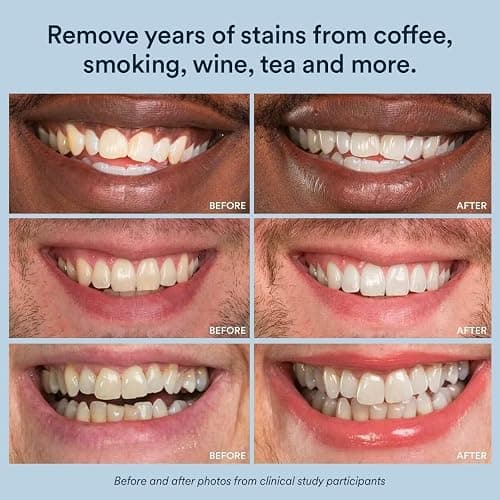 Auraglow 35% Teeth Whitening Gel for Trays, Retainers & Aligners – Dentist Strength Carbamide Peroxide Whitener, 30 Treatments, 3 Syringes (5mL) thumbnail 6
