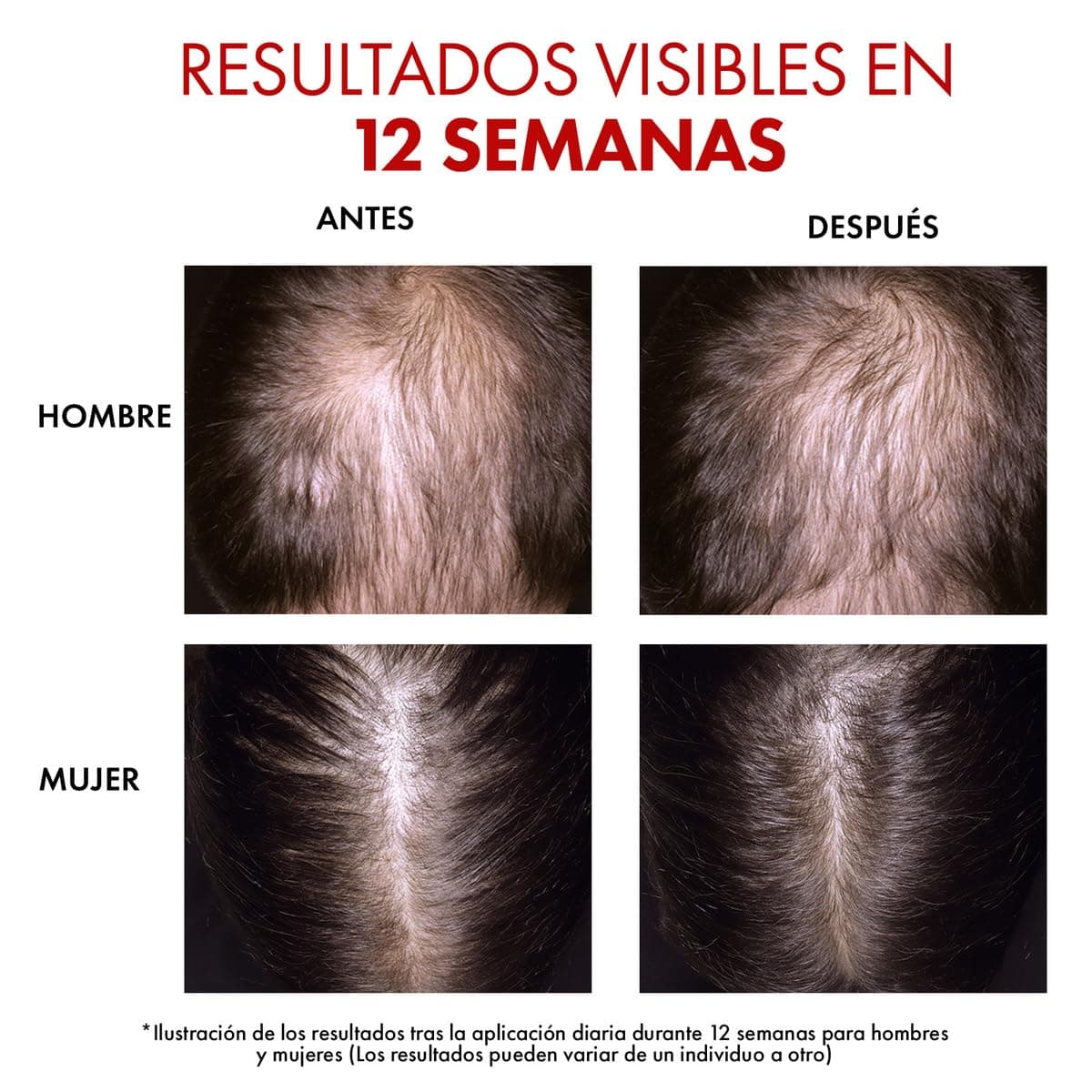Vichy DERCOS Aminexil Clinical R.E.G.E.N Booster, Primer Sérum Regenerador Capilar, Reduce la Caída del Cabello y Estimula su Crecimiento, Para Todo Tipo de Cuero Cabelludo, 90 ml thumbnail 7
