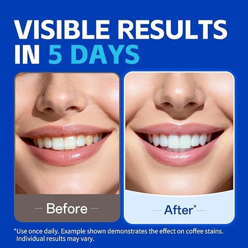 PERSMAX Teeth Whitening Strips – Professional Dentist Approved, Gum-Safe Formula, 14 Treatment, 28 Non-Slip Strips Kit, Pain-Free Express Whitening in 30-Min, Easy to Use for Bright Smile thumbnail 2