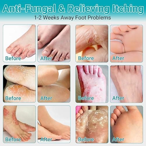 LMNOOP Athletes Foot Treatment Cream, Maximum Strength for Athlete's Foot (Tinea Pedis), Itching, Blister, Burning, Cracking, Scaling, Beriberi,Natural Herbs Antifungal Foot Cream thumbnail 4