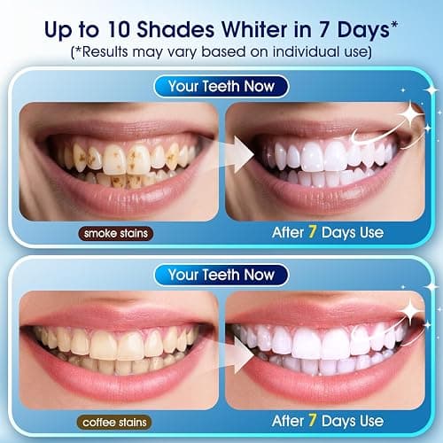 Teeth Whitening Kit – 3 Teeth Whitening Pens + 2 Desensitizing Pens – LED Light – 35% Carbamide Peroxide – Safe & Dentist-Recommended – Fast 7-Day Visible Whitening + Remineralizing Care thumbnail 2