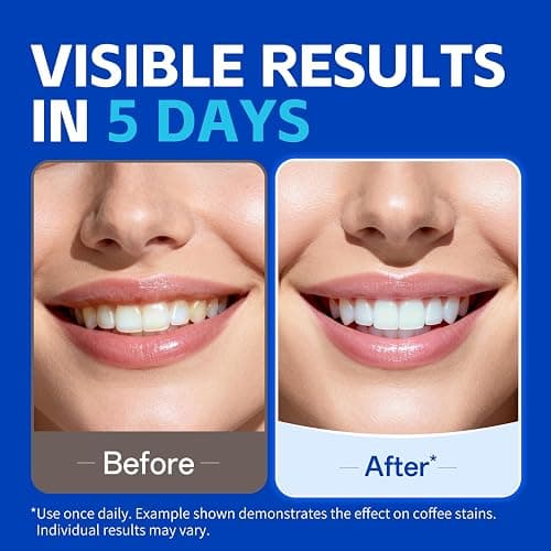 PERSMAX Teeth Whitening Strips, 18 Strips 9 Treatment (7 + 2 Bonus) | Non-Slip, Pain-Free, Express Whitening in 30 Min, Easy to Use for Confident Smile, Professional Dentist Approved thumbnail 2