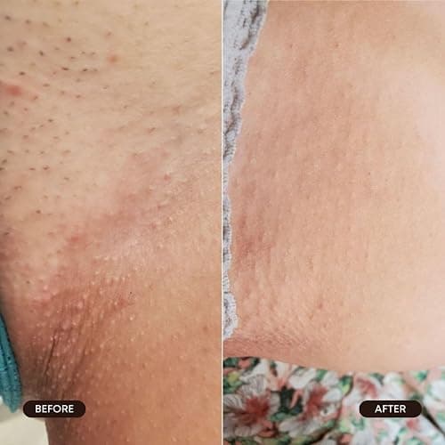 Bushbalm Roller Rescue Ingrown Hair Serum, Includes AHA and BHA - Exfoliating, Soothing, Cooling for Intimate Areas, Underarms - Helps With Razor Bumps and Ingrown Hairs, Blue 50 ml thumbnail 6