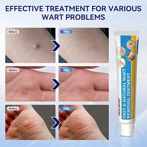 HEALMUSZ Wart Remover Contains 17% Salicylic Acid Skin Tag Remove Fast-Acting Natural Wart Removal Cream for Common Warts Plantar Warts Hand and Other Body Warts thumbnail 4