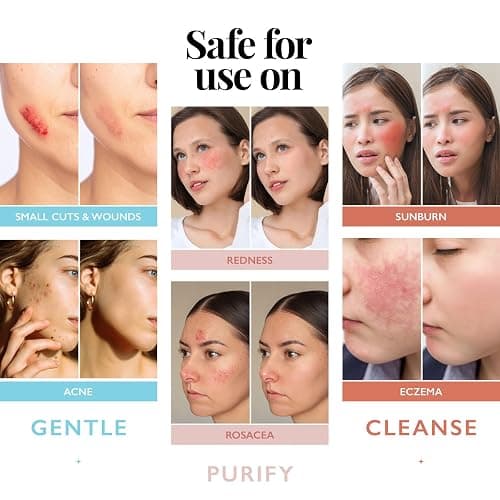 Hypochlorous Acid Spray for Face and Skin | Piercing Aftercare Spray | 8 oz Hypochlorous Acid Sprays for Face, Skin, Acne, Eczema, Body Acne Sprays, Piercing Aftercare, Facial Wound Solution, Workout thumbnail 3
