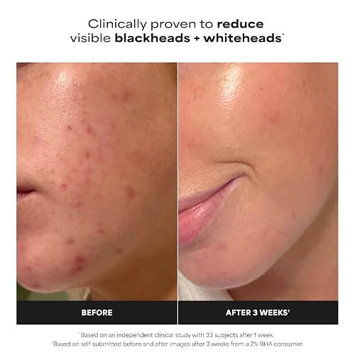 Paula's Choice SKIN PERFECTING 2% BHA Liquid Exfoliant - Face Exfoliating Peel Fights Blackheads & Enlarged Pores - for a Healthy Glow - with Salicylic Acid - Combination & Oily Skin - 30 ml thumbnail 5