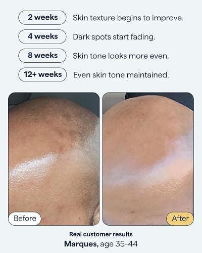 Remedy for Dark Spots – Discoloration Treatment For Face with Retinol, Glutathione, Niacinamide, Mandelic Acid, Kojic Acid and Tranexamic Acid – By Dermatologist Dr. Shah thumbnail 3