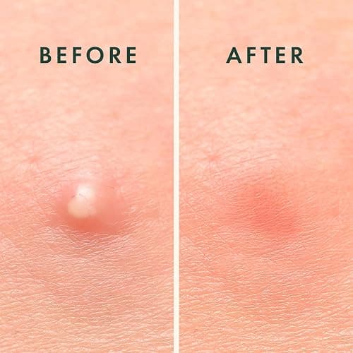 Rael Pimple Patches - Miracle Overnight Spot Cover, Thicker & Extra Adhesion, Hydrocolloid Acne Treatment for Face, Zits & Blemishes, Korean Skin Care, Vegan & Cruelty-Free, 3 Sizes (104 Count) - 104 Count (Pack of 1) thumbnail 7