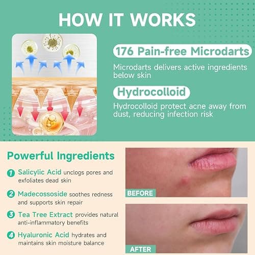 TEAWOO 36-Count Microdart Acne Patches, Hydrocolloid Pimple Patches with Salicylic Acid & Madecossoside, Microdart Zit Patches for Deep Blemishes & Early Stage Acne (Patented) thumbnail 5