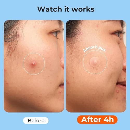 TKTK Hydrocolloid Pimple Patches All-in-One Combo Pack (9 Sizes 801 Count) | 7 Shapes Bulk Strips for Face & Back, Gentle Blemish Care for Acne, Zit Covering Set for Breakouts & All Skin Types thumbnail 5