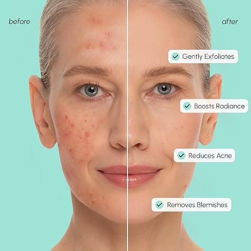 MAREE Azelaic Acid Acne Clearing Pads – Exfoliating Pads with Glycolic & Hyaluronic Acid for Face – 10% Azalecic Acid & Centella Redness Soothing Pad – Zero Pore Facial Toner Pad – Acido Azelaico thumbnail 4