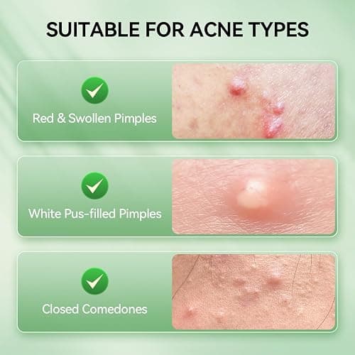 LANBENA 2% Salicylic Acid Spot Serum, 8H Rapid Acne Treatment for Acne-Prone Sensitive Skin, Fast-Acting Dry Out Pimples, Fade Acne Marks, Redness Relief, Overnight & Period Breakouts, 0.42 Fl Oz thumbnail 4