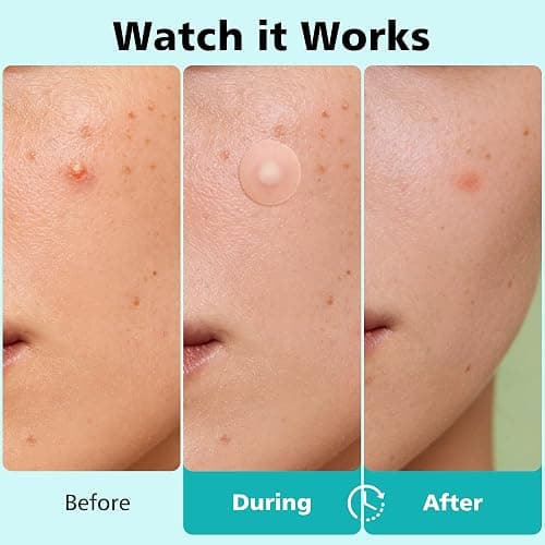 Dr.patch 600 Counts Pimple Patches - Hydrocolloid Acne Patches for face, Pimple Stickers for Covering Zits and Blemishes, Gentle for All Skin Types(4 Size) thumbnail 3