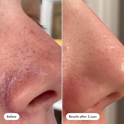 Mighty Patch Nose Patch and Pore Release from Hero Cosmetics thumbnail 6