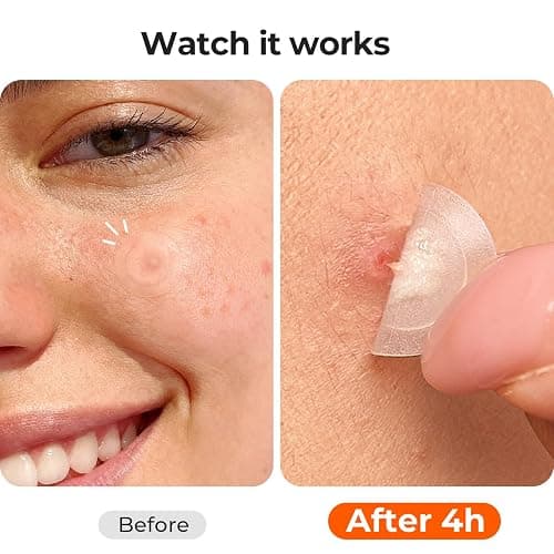 TKTK Pimple Patches for Face, 0.01cm Ultra-Thin Invisible Acne Patches, Hydrocolloid Patches for Breakouts, Absorbs Zits & Blemish, Suitable Under Makeup, 2 Sizes(10mm/12mm) 264 count thumbnail 4
