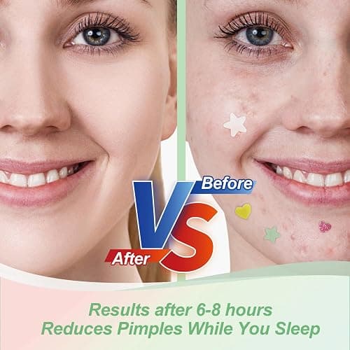 Star Pimple Patches for Face (400 Counts) Festival Beauty Party, Hydrocolloid Cute Acne Patches Cover Zits Blemishes, Zit Patches Spot Stickers Acid Tea Tree Oil,Zit Patches Pads for Skin Care thumbnail 5