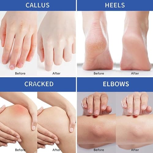 Intensive 60% Urea Cream for Cracked Heels & Dry Skin – Deep Moisturizing Foot & Hand Treatment – Softens Calluses on Feet, Knees & Hands – Ultra-Hydrating Formula for Smooth, Nourished Skin thumbnail 2