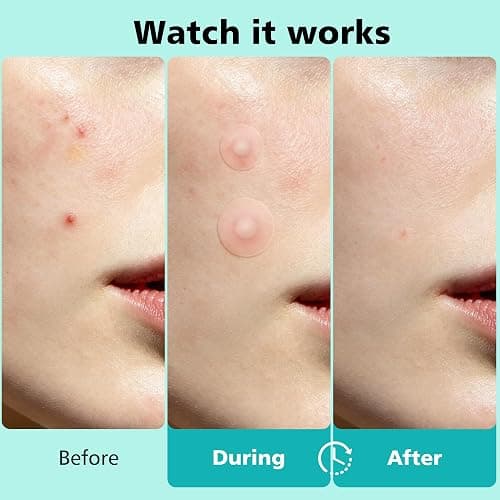 Dr.patch 563 Count Pimple Patches, Acne Patches for Face & Body | Hydrocolloid Patches, Invisible Thin, Large & Small Sizes for Whiteheads, Zits & Breakouts (Dots, Strip, Contoured 6 Sizes) thumbnail 4
