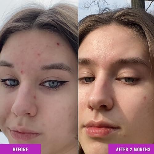 Good Molecules Niacinamide Serum - 10% Niacinamide to Target Acne, Nourishment, and Skin Tone - Ultra Hydrating Serum and Brightening Skin Care for Face thumbnail 4