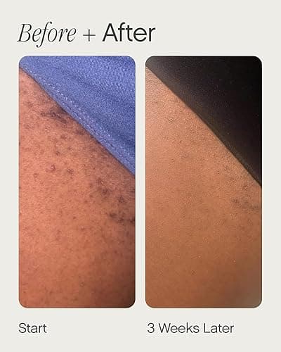 Topicals High Roller Ingrown Hair Serum | Roll-on Tonic to Soothe and Calm Irritated Skin on Face, Armpits and Bikini Areas | Contains Salicylic and Glycolic Acid | Vegan and Cruelty-Free (1.7 Fl Oz) thumbnail 7