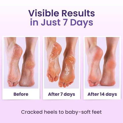 Foot Peel Mask for Hard Skin (6 pairs) Foot Mask for Cracked Heel Solution, Dry Feet Care with Lavender & Shea Butter, Dead Skin Remover, Exfoliating Socks for Women & Men, One Size Fits Most thumbnail 4