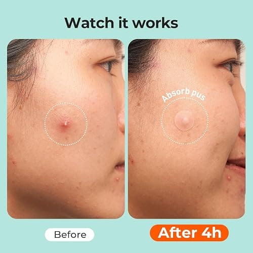 TKTK 443 Count Pimple Patches for Face, Hydrocolloid Acne Cover Patch Bulk | Pimple Stickers for Cheeks, Forehead, Chin Blemishes Zit & Breakouts, All Skin Types, Dots, Strips, Contoured 5 Sizes Variety thumbnail 6