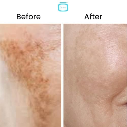 10% Tranexamic Acid Cream – 1 fl oz / 30ml – Skin Brightening Cream - Skin Moisturizer, Even Skin Tone with Coconut Oil & Vitamin E thumbnail 3