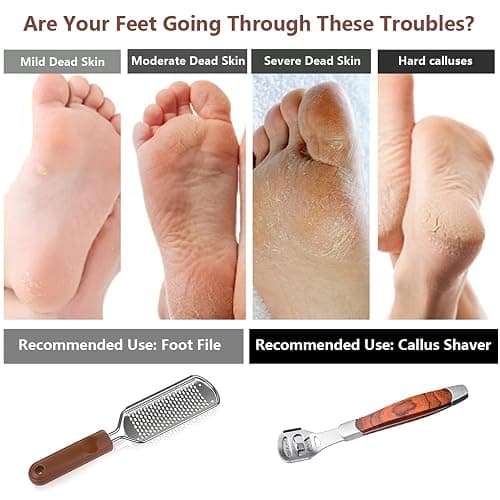Colossal Foot Rasp & Wood Handle Callus Shaver (10 Replacement & 1 File Foot Heads), Pedicure Foot File Kit, Heel Scraper for Feet, Foot File Callus Remover thumbnail 5