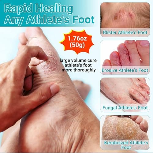 LMNOOP Athletes Foot Treatment Cream, Maximum Strength for Athlete's Foot (Tinea Pedis), Itching, Blister, Burning, Cracking, Scaling, Beriberi,Natural Herbs Antifungal Foot Cream thumbnail 2