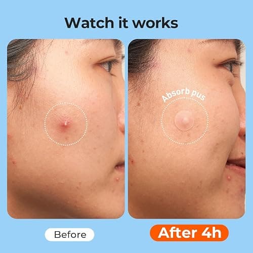 TKTK 609 Count Pimple Patches for Face, Hydrocolloid Acne Cover Patch Bulk | Pimple Stickers for Cheeks, Forehead, Chin Blemishes Zit & Breakouts, All Skin Types, Dots, Strips, Contoured 5 Sizes Variety thumbnail 6
