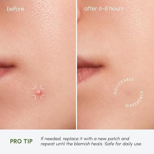 MAREE Invisible Pimple Patches 2 PACK - Clear Pimple Patches for Face - Hydrocolloid Acne Patches Anti Blemish - Zit Stickers for Face - Parches Para Acne - Pinple Zit Pimple Stickers - 144 Dots thumbnail 7