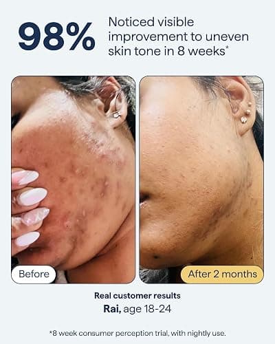Remedy for Dark Spots – Discoloration Treatment For Face with Retinol, Glutathione, Niacinamide, Mandelic Acid, Kojic Acid and Tranexamic Acid – By Dermatologist Dr. Shah thumbnail 7