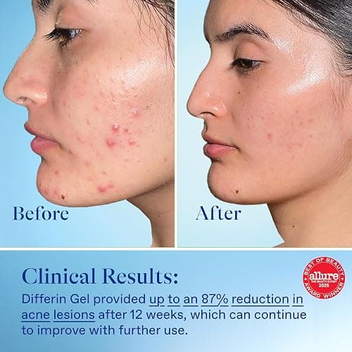 Differin Acne Treatment Gel, 60 Day Supply, Retinoid Treatment for Face with 0.1% Adapalene, Gentle Skin Care for Acne Prone Sensitive Skin, 15g Tube (Pack of 2) (Packaging May Vary) | Pack Of 2, 60-Day Supply, OTC Retinoid, Clears Breakouts, Gentle On Sensitive Skin, Dermatologist Recommended thumbnail 5