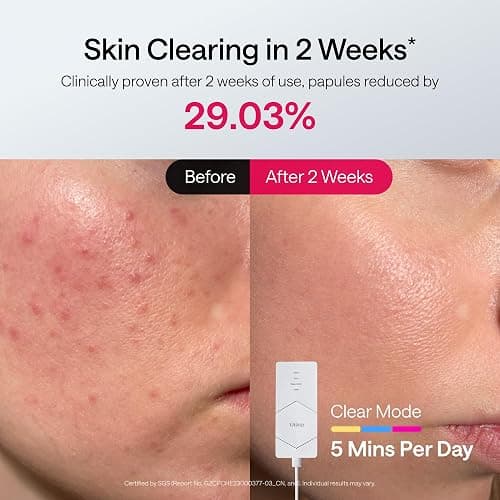 Ulike Light Therapy Mask($100 off coupon) thumbnail 5