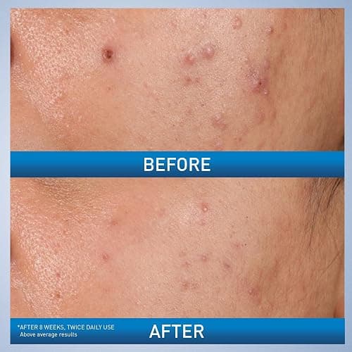 CeraVe Acne Control Gel, 2% Salicylic Acid Treatment With Glycolic Acid + Lactic Acids + Niacniamide, Acne Gel Helps Clear Blemishes Without Over Drying, Alcohol Free & Oil Free, 1.35 Fl Oz thumbnail 2